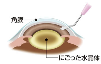 角膜の切開
