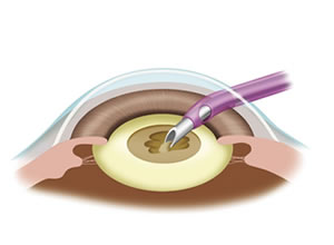 濁った水晶体の削除