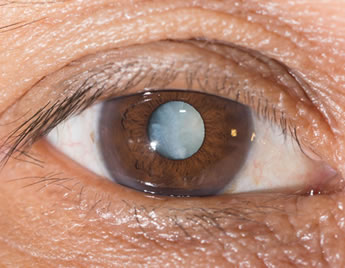 白内障の目