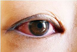 アレルギー・結膜炎